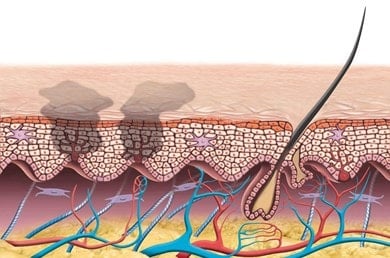 Illustration zeigt Hautquerschnitt mit Pigmentbildung durch UV-Strahlung