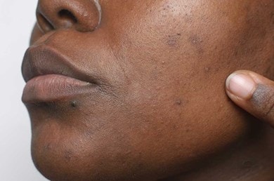 Nahaufnahme dunkler Haut mit Pigmentstörungen, Finger deutet auf Pigmentflecken