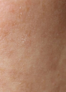 Nahaufnahme von Haut mit Feuchtigkeitsmangel und feinen Trockenheitslinien