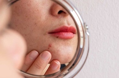 Mund, Kinn und Wange einer Frau im Spiegel mit unreiner Haut und rot geschminkten Lippen